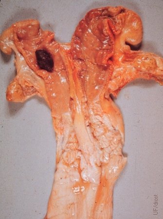 Uterus Didelphys with Hysterolith.