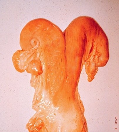 Postpartum Uterus - Day 30.