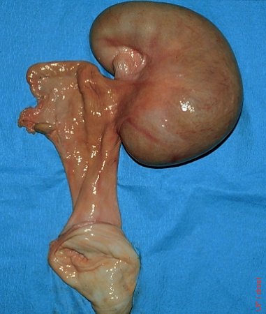 Segmental Hypoplasia.