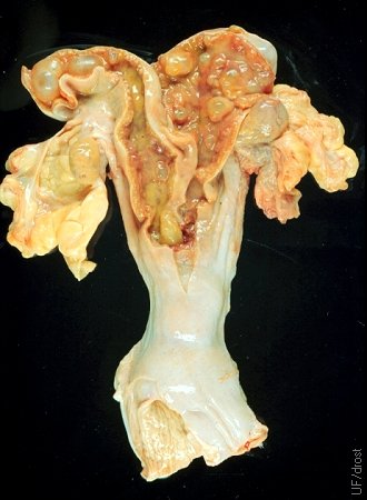 Bilateral Cystic Endometrial Hyperplasia.