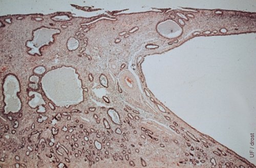 Histology of Cystic Endometrium.