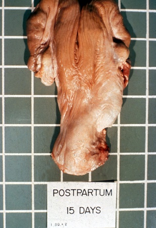 Postpartum Uterus - Day 15.