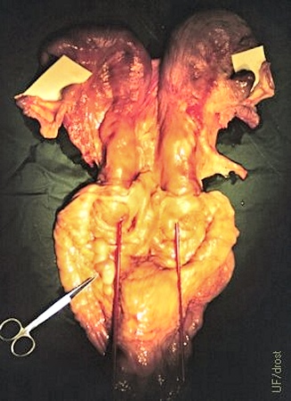 Uterus Didelphys.