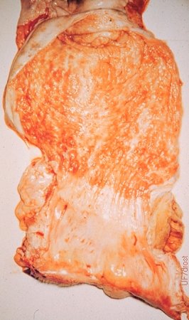 Lymphomatosis of the Vagina.