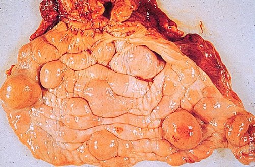 Lymphosarcoma of the Vagina.