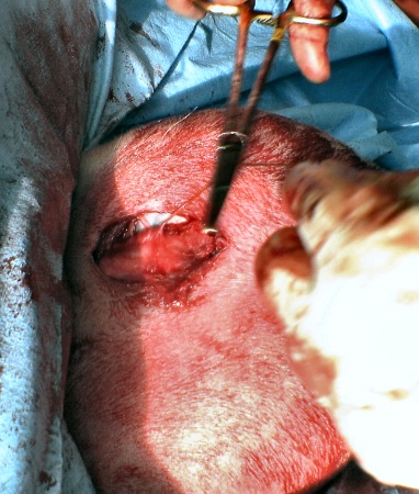Vasectomy 6.