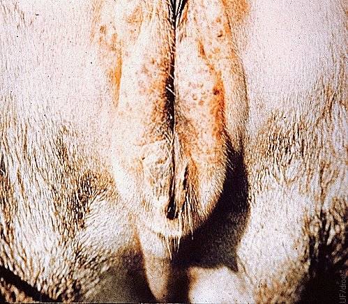Edema of the Vulva.