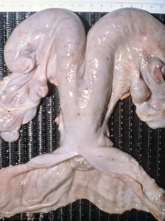 Fluid-filled Uterus.