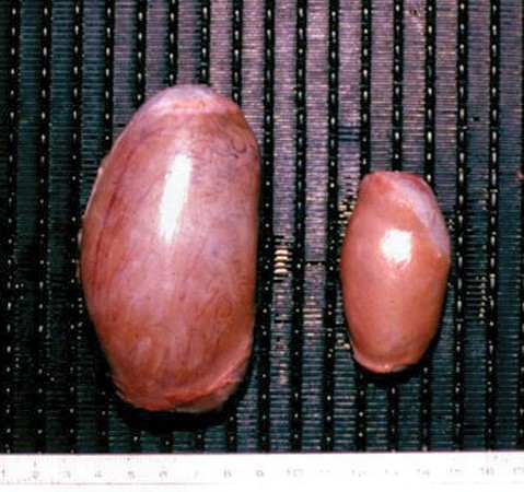 Unilateral Testicular Hypoplasia.