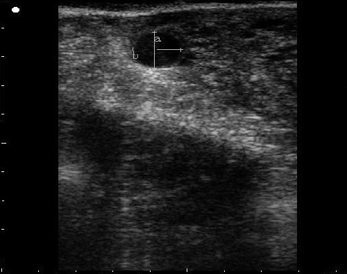 Ovary with a pre-ovulatory follicle.