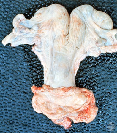 Normal Pluriparous Uterus.