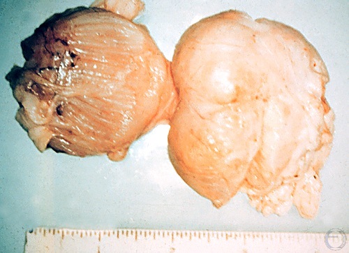 Prostatic Tumor.