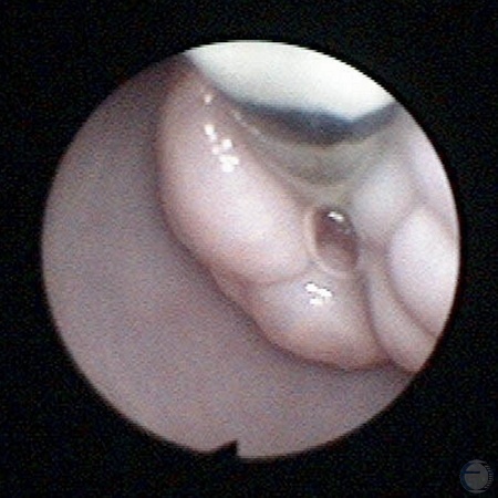 View of the Cervix by Vaginal Endoscopy.
