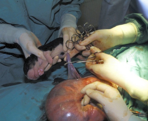 Clamping the Umbilical Cord.