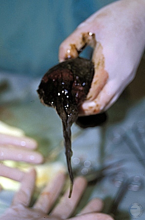 Removal of the Placenta.