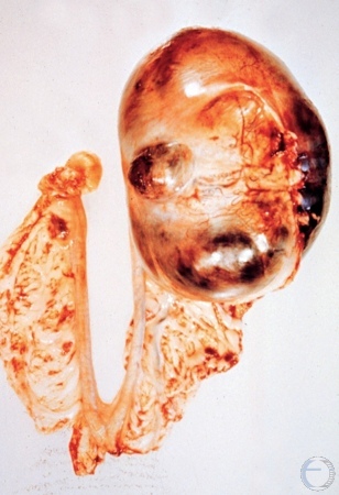 Cystic Granulosa Cell Tumor.