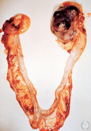 Granulosa Cell Tumor.