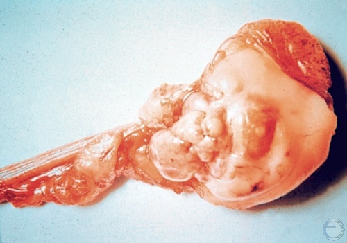 Ovarian Cystadenoma.