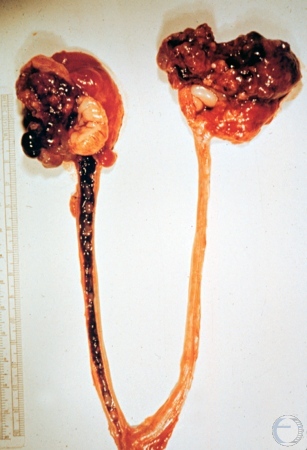 Cystic Adenocarcinoma.