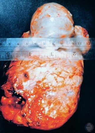 Mastocytoma.
