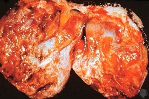 Mastocytoma Cross-section.