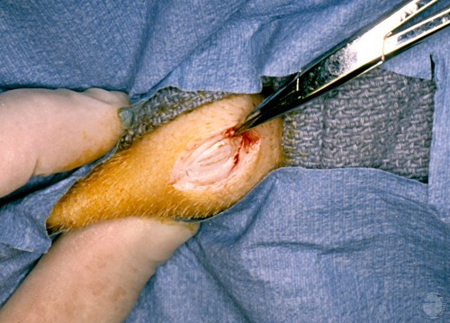 Testicular Biopsy.