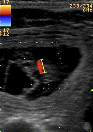Ultrasound Image of Beating Heart.