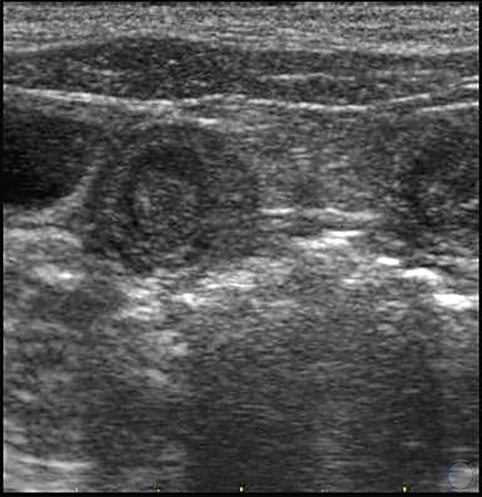 Ultrasound Image of Embryonic Vesicles.