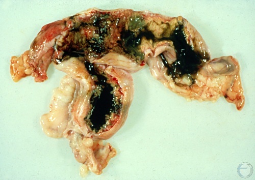 Postpartum Uterus.
