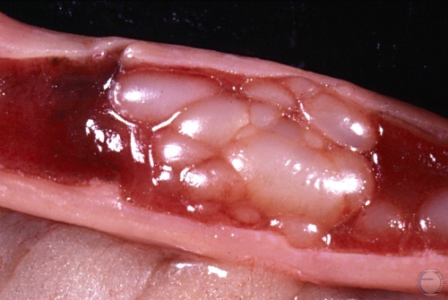 Cystic Endometrial Hyperplasia.