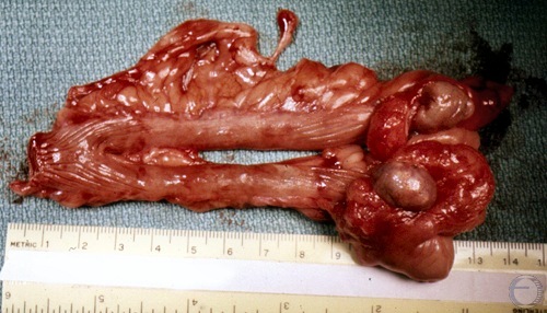 Uterus and Ovaries.