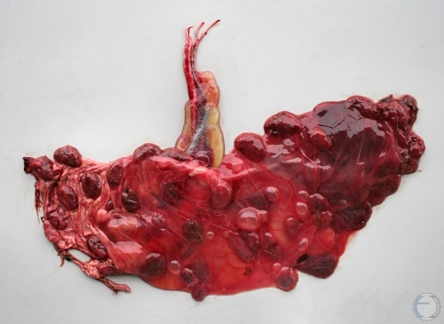 Placenta of Aborted Twins.