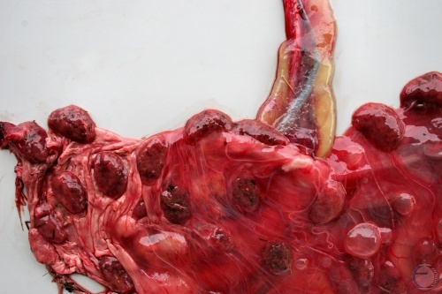 Close-up of Placenta of Aborted Twins.