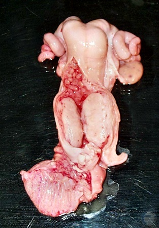 Cervical Leiomyoma.