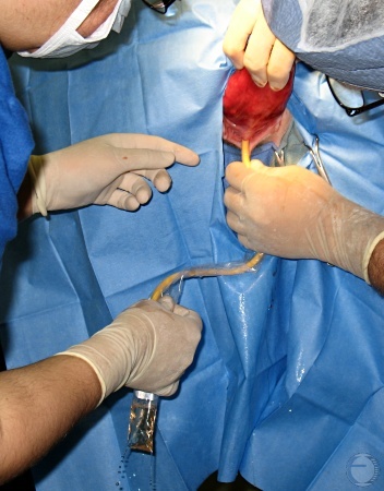 Catheterization of the Bladder.