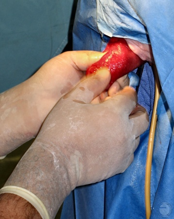 Positioning of the Prolapse.