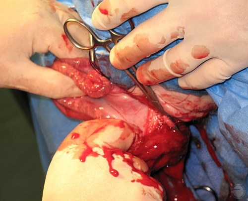 Extracting the Uterus.