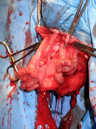 Uterine Artery.