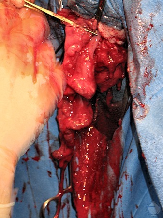 Cutting the Broad Ligament.