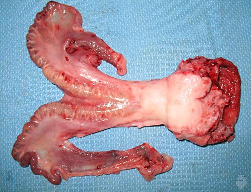 Excised Uterus.