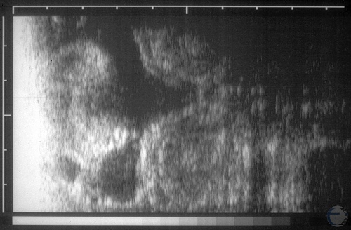 Ultrasonogram at 2 Months.