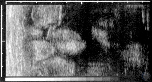 Ultrasonogram at 2 Months.
