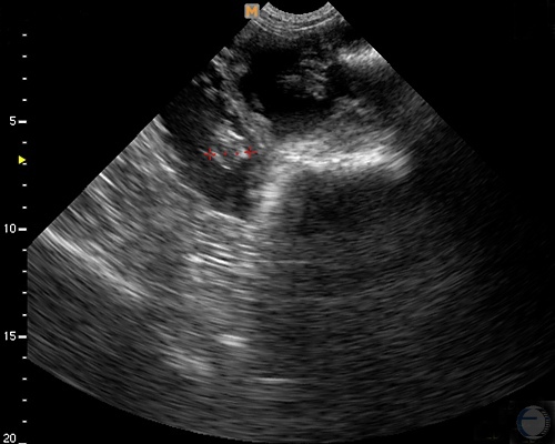 Ultrasonogram at 9 Weeks.