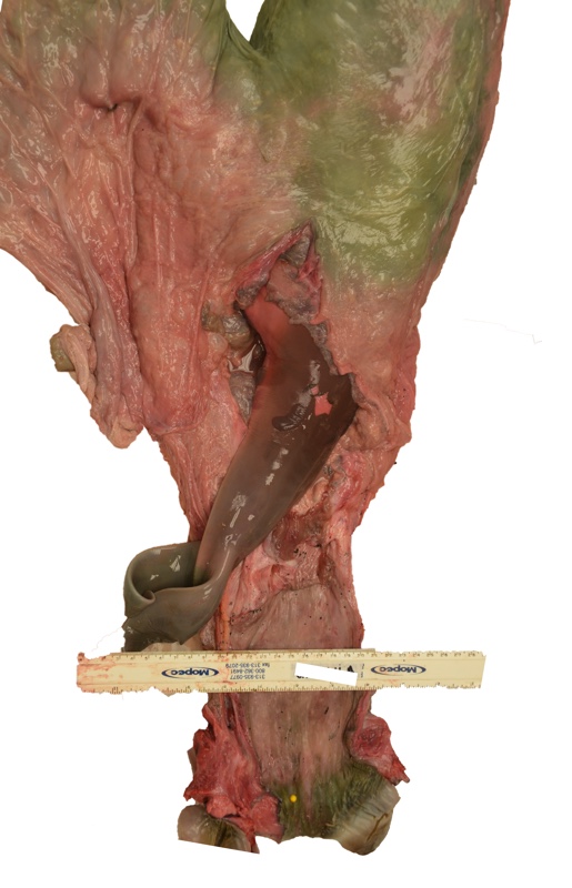 Fetus attached to left uterine horn.