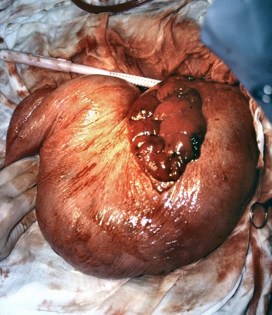 Uterine Tear.