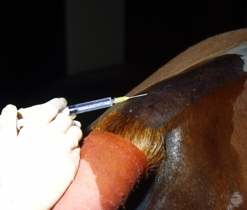 Epidural Anesthesia - Skin Injection.