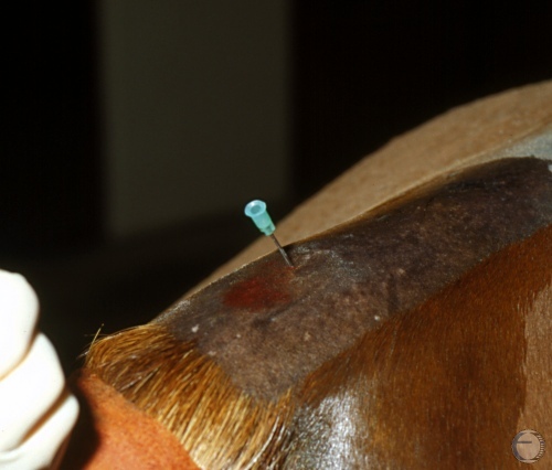 Epidural Anesthesia - Needle Angle.