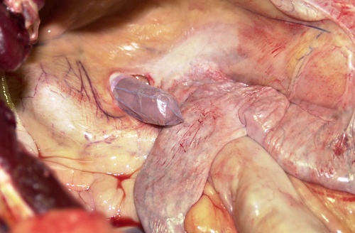 Colpotomy: Stab Incision.