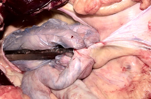 Colpotomy: Ovary Cupped in Hand.