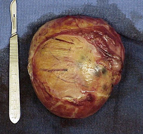 Intact Granulosa Cell Tumor.